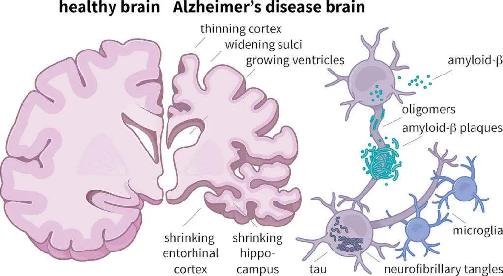 Alzheimer's brain and healthy brain comparison thinning cortex widening sulci